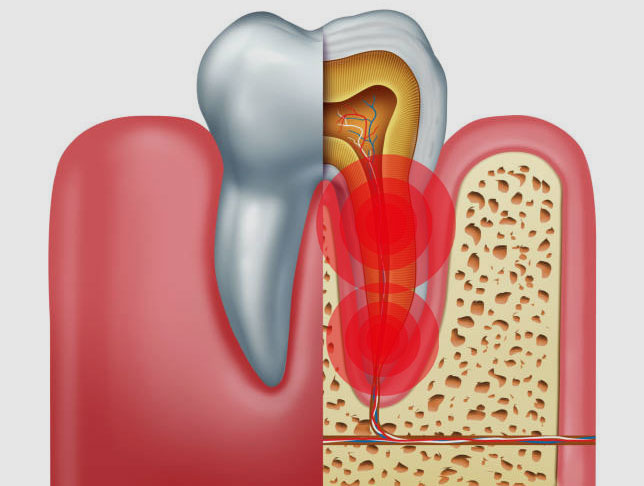 Endodoncia