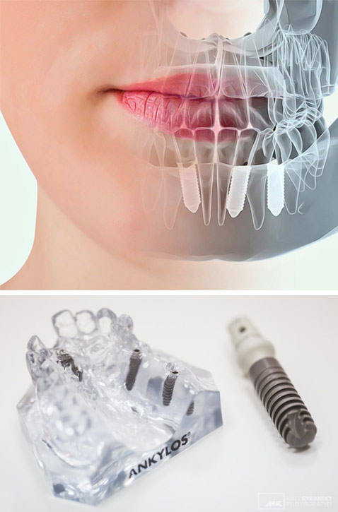 Implantológia